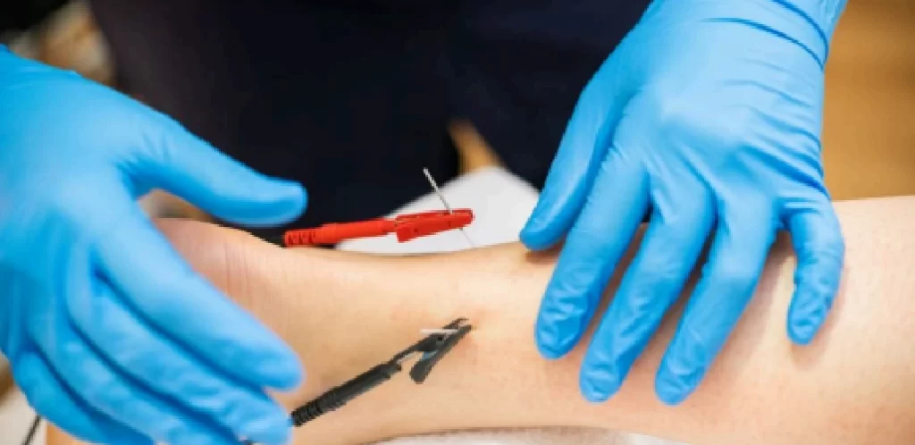 Dry-Needling-Blog-Post-Impact-Physical-Therapy